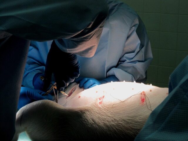 Choisir un antalgique après une chirurgie digestive